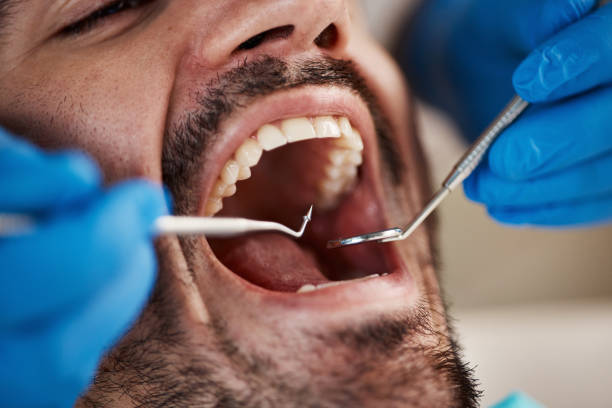 Best Emergency Dentist for Lost Fillings or Crowns in Pickens, MS